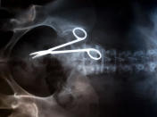 An X-ray showing a 17centimeter (6.7 inches) pair of surgical scissors in the abdomen of 69-year-old Pat Skinner in Sydney, Australia, Tuesday, April 20, 2004. Mrs Skinner had an operation at St.George hospital in Sydney's south in May 2001, but continued to suffer intense pain and it was only when she insisted on an x-ray 18 months later that she discovered the scissors inside. (AP Photo/Rob Griffith)