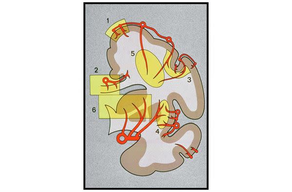 （圖為大腦血流供應示意圖）