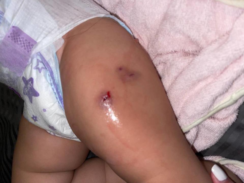 A photo showing an abscess that one of the children represented in the lawsuit developed shortly after getting routine childhood vaccination.
