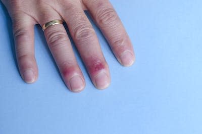 Although they usually heal if protected from cold, chilblains can be painful. <a href="https://www.gettyimages.com/detail/photo/chilblains-on-the-fingers-royalty-free-image/1372816804?phrase=chilblains&adppopup=true" rel="nofollow noopener" target="_blank" data-ylk="slk:Elizabeth Fernandez/Moment via Getty Images;elm:context_link;itc:0;sec:content-canvas" class="link ">Elizabeth Fernandez/Moment via Getty Images</a>