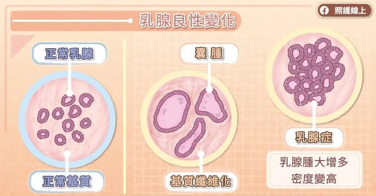 乳腺症是什麼？