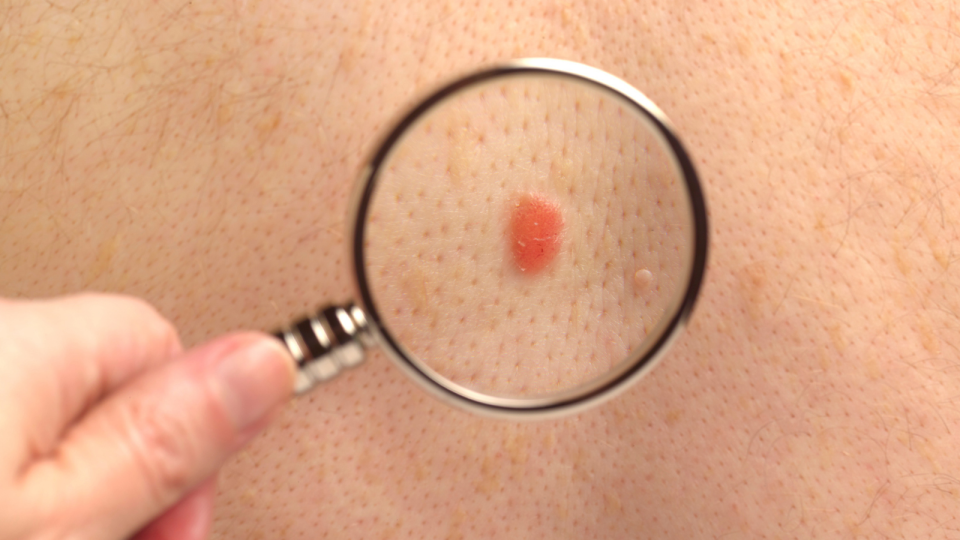 Magnifying glass over strange mark on white person's skin.