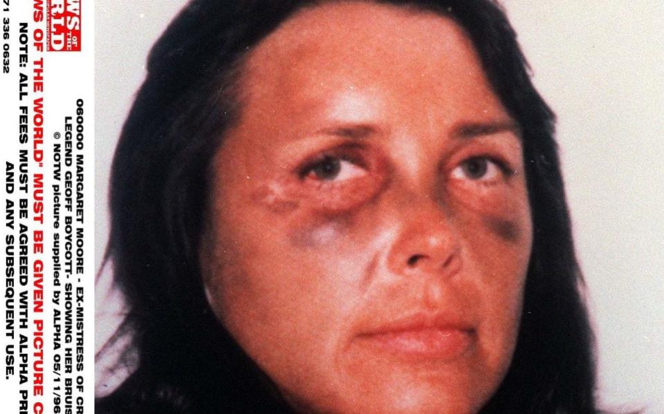 Margaret Moore with a bruised face in 1998. Sir Geoffrey Boycott was convicted of assaulting her - News of the World