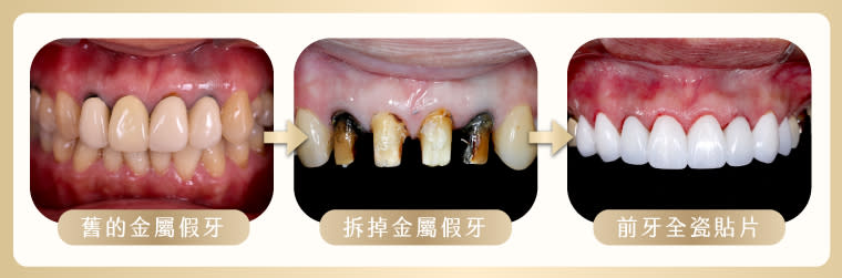 <strong>患者前排的舊假牙，牙肉發炎，金屬外露，治療過程先將上排4顆金屬全瓷冠門牙拆掉。楊大為醫師強調，全瓷貼片、瓷塊補牙裝上後，幾乎是將牙齒恢復到新生的強度與密合度，使用年限可達至少10年以上。（圖／祐民牙醫診所提供）</strong>