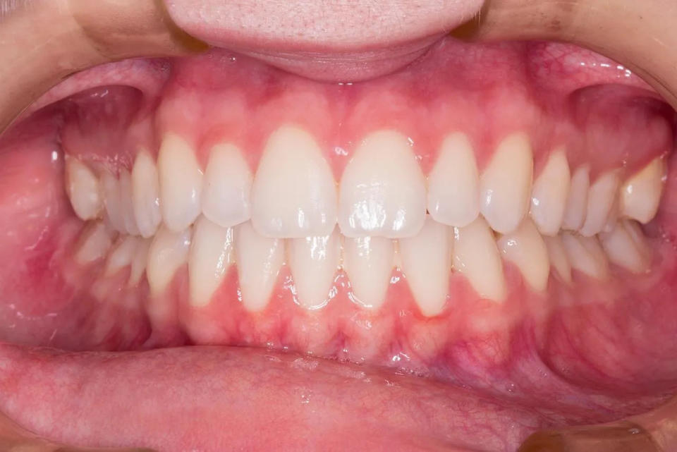 <strong>牙齦腫脹通常與火氣大無直接關聯，大多是受到口腔健康狀況的影響。（示意圖／pixabay）</strong>