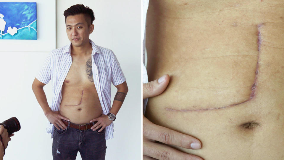 Hanwei showing media on 11 July, 2019, his scar from the liver donor operation in May. (PHOTO: Dhany Osman/Yahoo News Singapore)