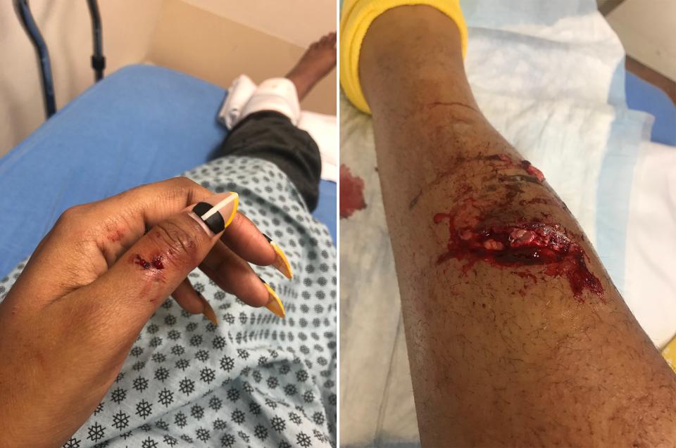 The police dog, named Drogo, bit Brooks on her thumb and leg. These photos were taken less than an hour after the attack. (Photo courtesy of Ayanna Brooks)