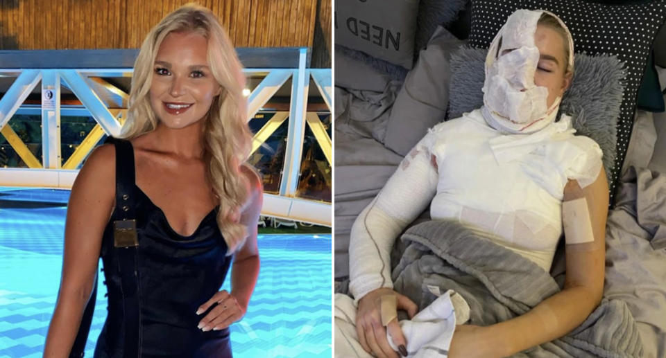 Abbie Quinnen, 23, is pictured in a hospital bed with burns.