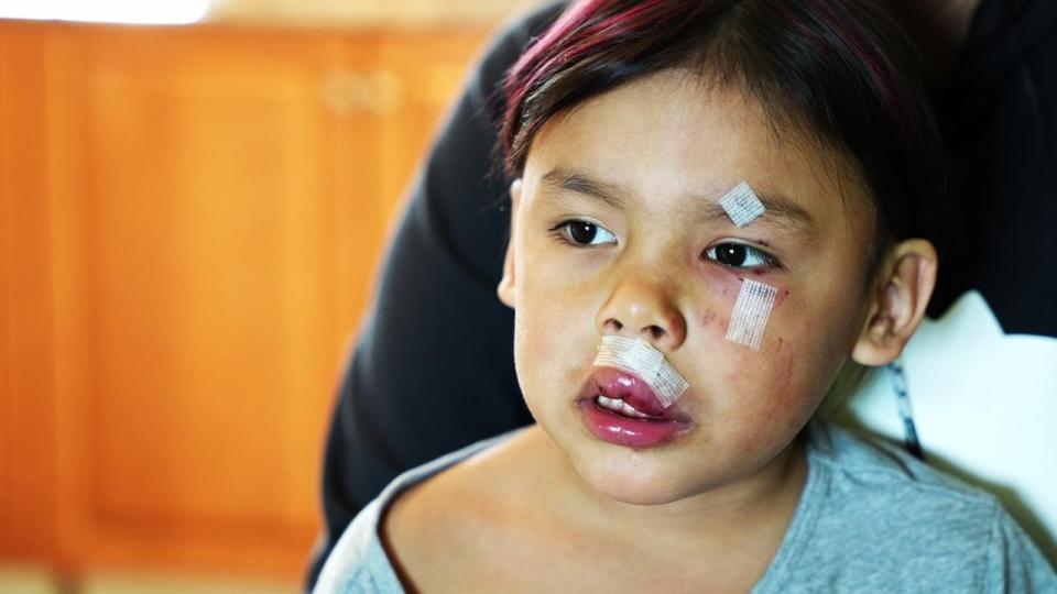 Mary-Lou Nuna said her six-year-old daughter is fearful to play outside after the dog attack. 