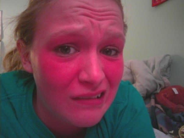 1st degree sunburn on face