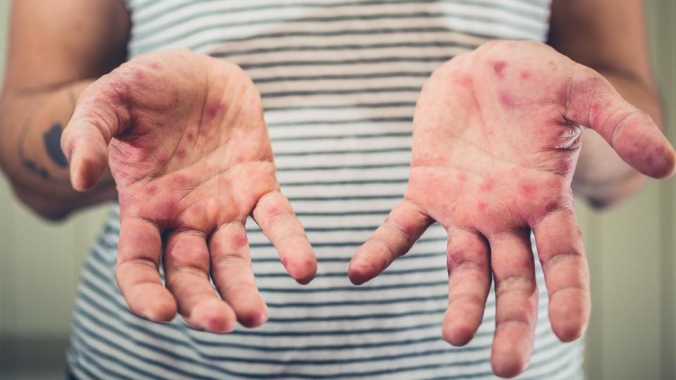 Measles, hand foot and mouth disease, istock