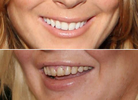 Lindsay's teeth in 2008 (top) and today (bottom). Photo credit: Getty Images