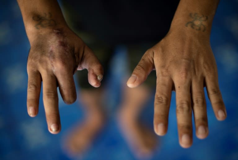 Myanmar migrant worker Kyaw Thet Oo says he was never compensated for his disfigured right hand from a work accident in Thailand