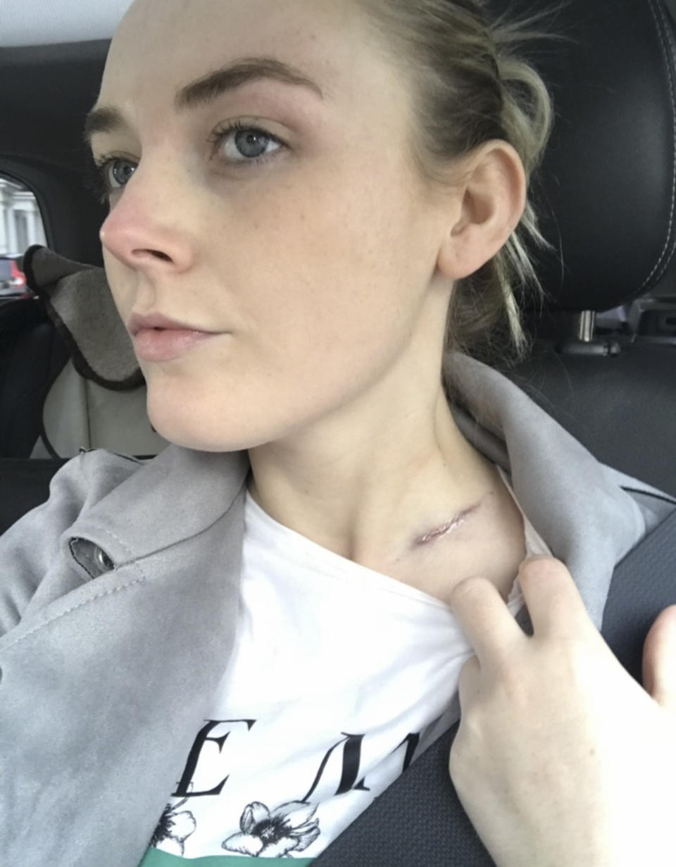 A photo of Georgie Swallow showing a scar on her neck.