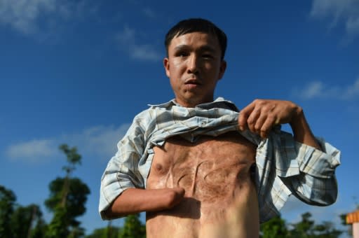 Vietnamese landmine victim Nguyen The Nghia in January 2020 shows his wounds caused by a munitions explosion when he was younger in Quang Tri province