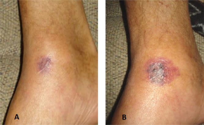 Rapidly developing and fatal Vibrio vulnificus wound infection (Image appears courtesy of Elsevier. Copyright Elsevier 2016)