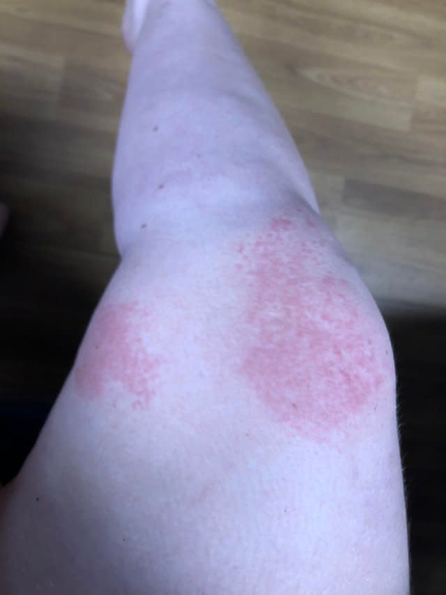 A swimmer shared a picture of her jellyfish sting at Williamstown beach. Source: Reddit/dogfan96
