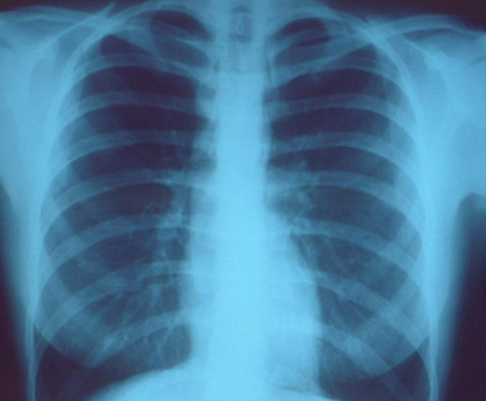 A chest X-ray shows a healthy set of lungs with no inflammation.