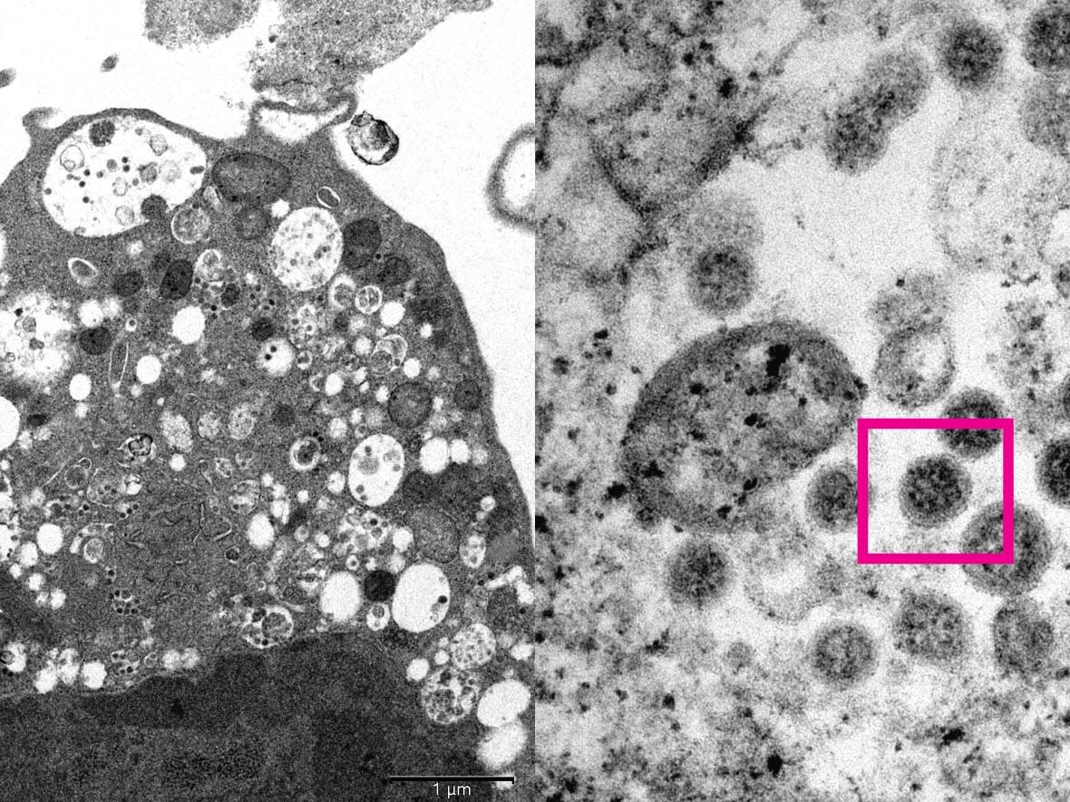 A close-up look at the Omicron variant of SARS-CoV-2. At left, low magnification electron micrograph imaging shows a cell after infection. At right, high magnification electron micrograph imaging shows that infected cell and viral particles with corona-shaped spikes on their surface. (HKUMed and Electron Microscope Unit/HKU - image credit)