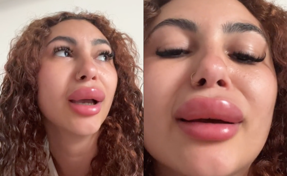 A TikToker with lip filler shared a video of her swollen lips during a trip to Italy.  (TikTok/@prettygirlbianca2)