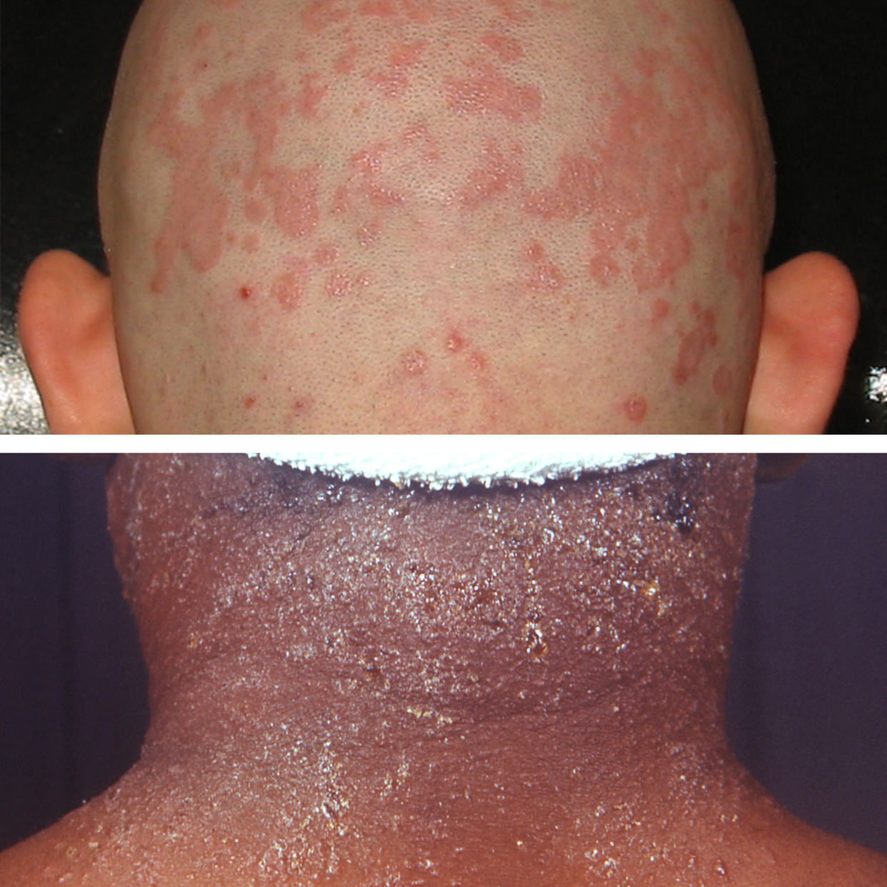 seborrheic dermatitis