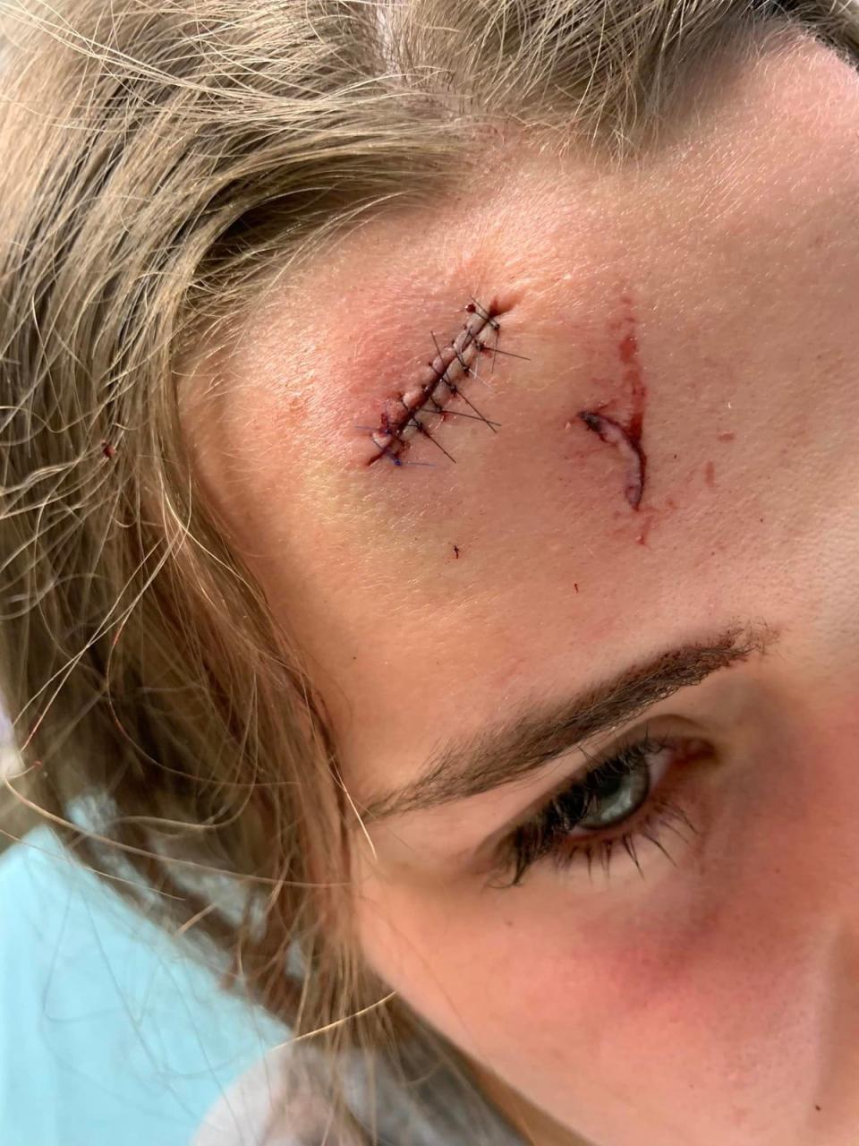 The 18-year-old posted an image of her injury to Facebook before being rushed back to hospital on Thursday (Rebecca Gillespie  / Facebook)