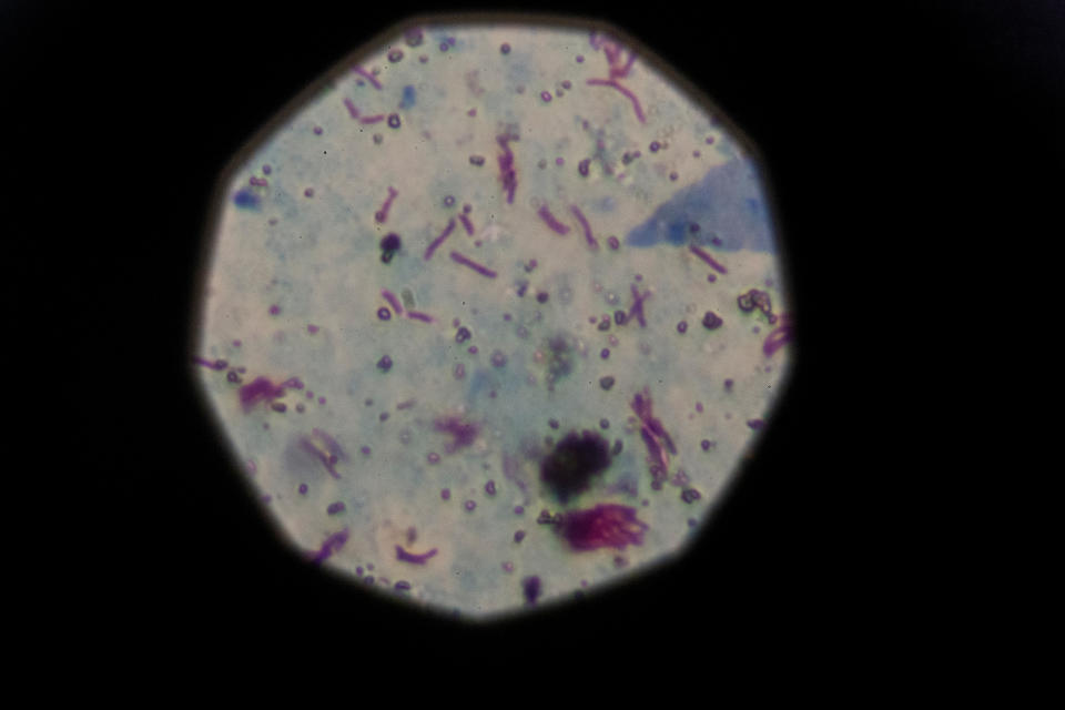 A sample that tested positive for tuberculosis is seen from a microscope in Buenos Aires, Argentina, March 29, 2019. Cases of the "white death" illness, closely linked to poverty, malnutrition and poor housing, have been on the rise since the turn of the decade as Latin America's third largest economy has grappled with repeat recessions and inflation. (Photo: Magali Druscovich/Reuters)