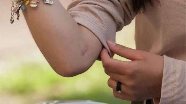 PHOTO: Dasha Pivtoratska, 14, a Ukrainian girl whose family was firing on indiscriminately, shows the pink scars from her bullet wounds. (ABC News)