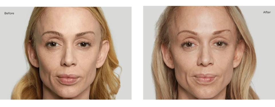 Sculptra Before and After