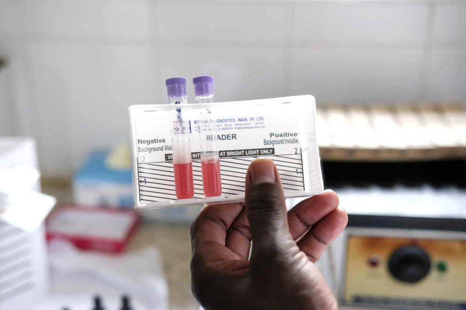 A laboratory technician examines sickle cell blood samples, at the Mbale Regional Referral Hospital in Mbale, Uganda, Wednesday, April 24, 2024. There can be lifelong challenges for people with sickle cell disease in rural Uganda, where it remains poorly understood. (AP Photo/Hajarah Nalwadda)