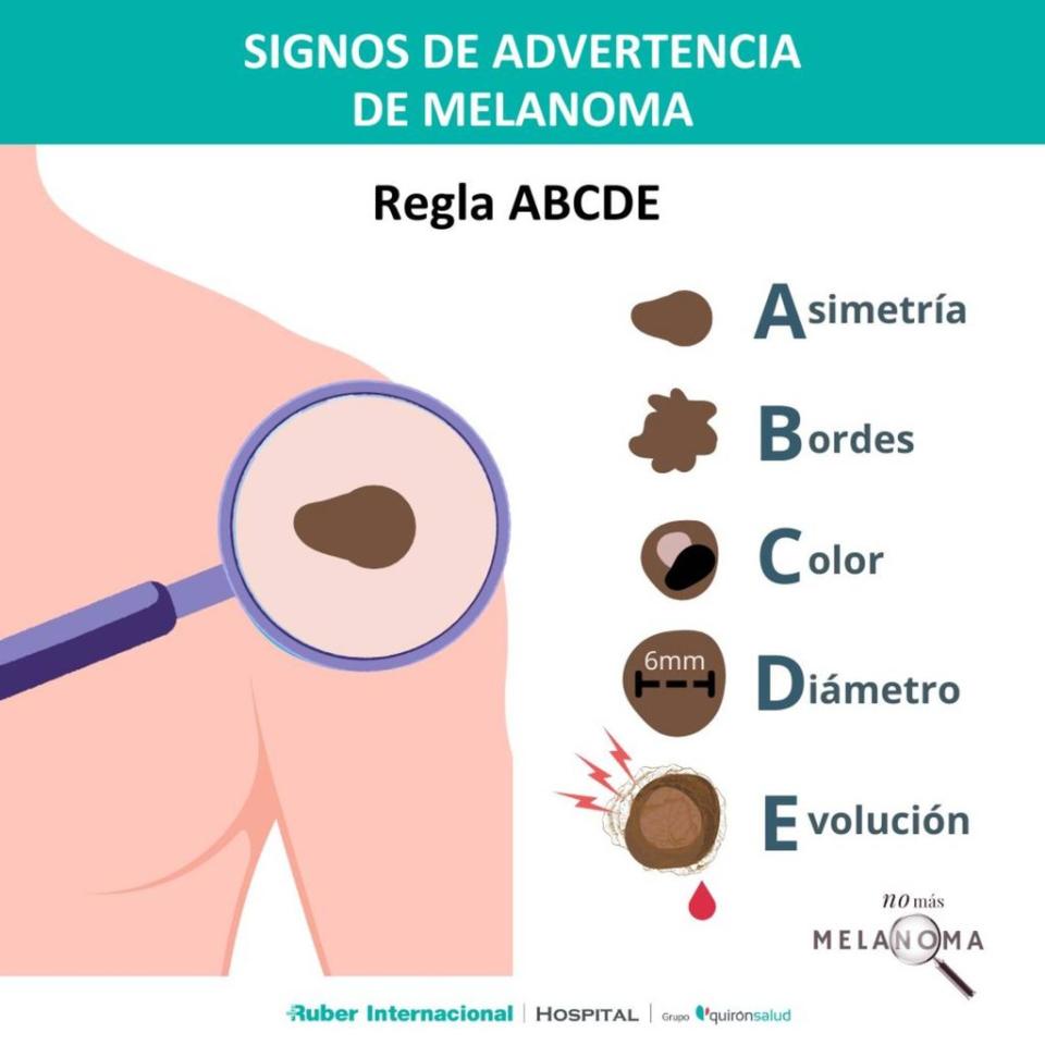 Imagen que describe cómo identificar un melanoma