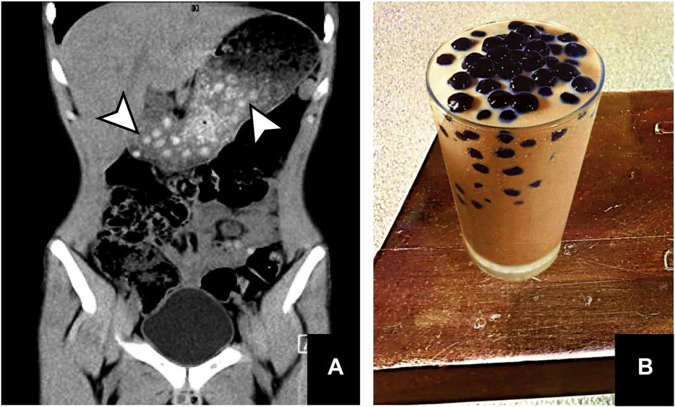 A CT scan shows tapioca pearls in a boy's abdomen. Also pictured is a glass of bubble tea.