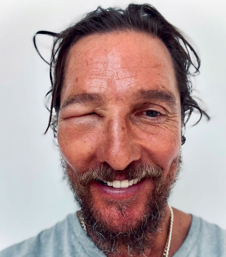 Matthew McConaughey muestra cómo le ha quedado la cara tras la picadura de una abeja