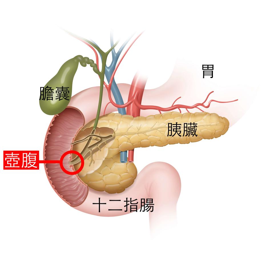 「壺腹」位在膽管和胰管相會進入十二指腸的交界處，當此處的括約肌長出惡性腫瘤，就是壺腹癌（原始圖片來源：Getty Image）