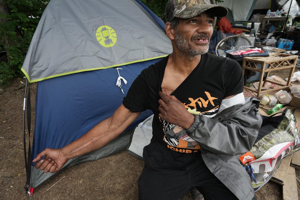 June was, 2022; Columbus, Ohio; Tony Holbrook lives at a homeless camp near the now closed Heer Park at 125 W. Williams Ave. He displays his scars from what he said was when he had a flesh-eating virus Fred Squillante-The Columbus Dispatch