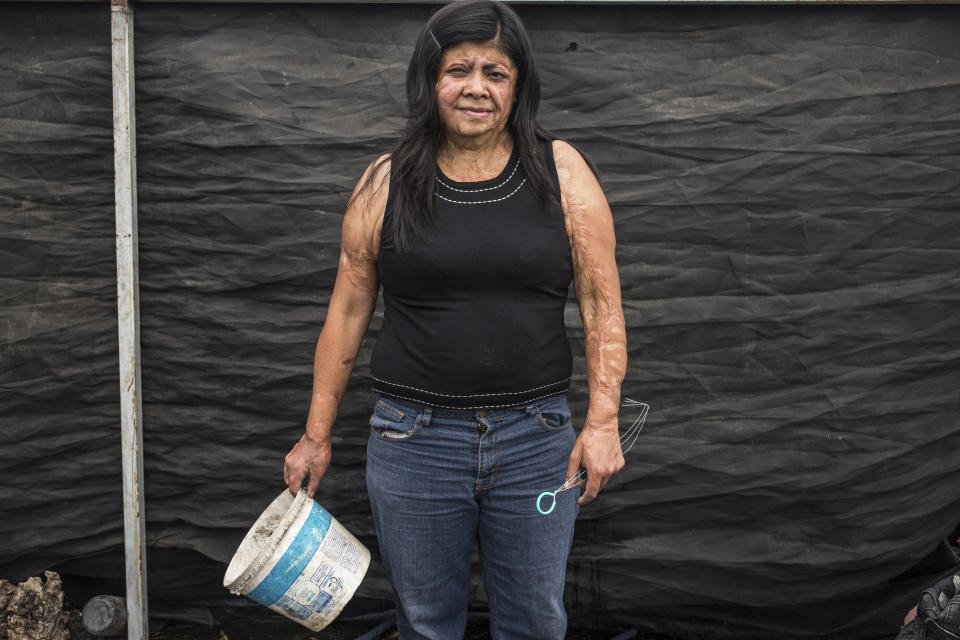 Elisa Xolalpa, who survived an acid attack while tied to a post by her ex-partner 20 years ago when she was 18, poses for a portrait in her greenhouse in Mexico City, Saturday, June 12, 2021. Survivors like Xolalpa want the attacks classified as attempted femicide, aid with the innumerable surgeries that follow and psychological support. (AP Photo/Ginnette Riquelme)