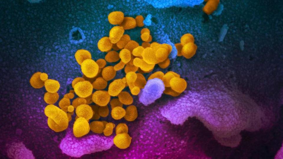 This undated electron microscope image made available by the U.S. National Institutes of Health in February 2020 shows the Novel Coronavirus SARS-CoV-2, yellow, emerging from the surface of cells, blue/pink, cultured in the lab. Also known as 2019-nCoV, the virus causes COVID-19. The sample was isolated from a patient in the U.S. (NIAID-RML via AP)