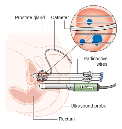 By placing the radioactive source inside the body, brachytherapy can target tumors more directly than external beam radiotherapy. <a href="https://commons.wikimedia.org/wiki/File:Diagram_showing_how_you_have_high_dose_brachytherapy_for_prostate_cancer_CRUK_419.svg" rel="nofollow noopener" target="_blank" data-ylk="slk:Cancer Research UK/Wikimedia Commons;elm:context_link;itc:0;sec:content-canvas" class="link ">Cancer Research UK/Wikimedia Commons</a>, <a href="http://creativecommons.org/licenses/by-sa/4.0/" rel="nofollow noopener" target="_blank" data-ylk="slk:CC BY-SA;elm:context_link;itc:0;sec:content-canvas" class="link ">CC BY-SA</a>