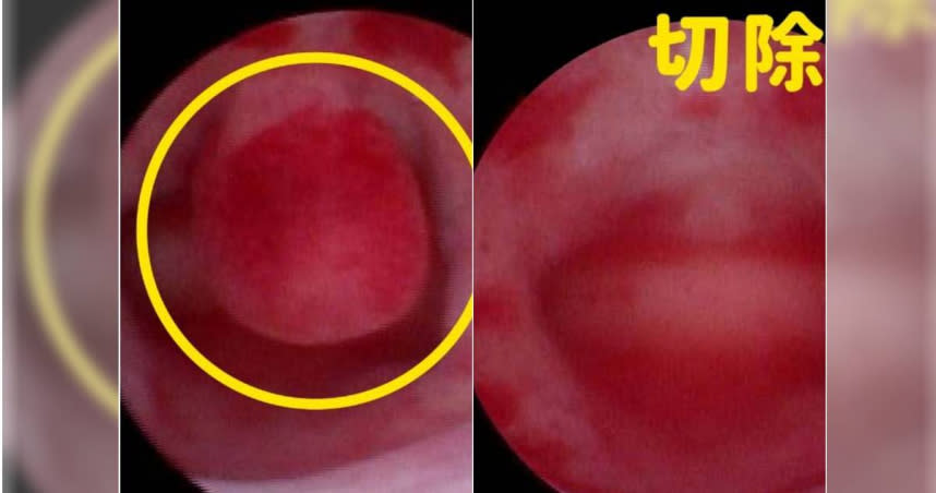 女子子宮有3公分瘜肉，接受無創冷刀子宮鏡手術，可避免子宮腔內沾黏，保留受孕機會。（圖／中醫大新竹附醫提供）