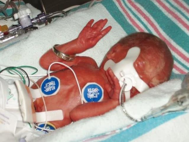 <p>Sarah Crichigno</p> Hope Crichigno as a baby in the neonatal intensive care unit