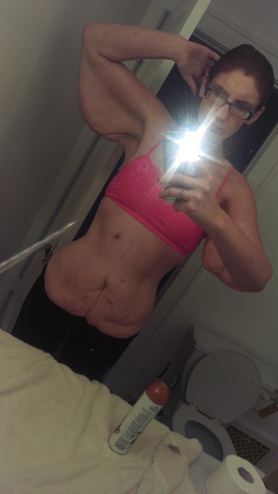 Nach der Gewichtsreduktion hatte Hallie Babcook viel überschüssige Haut am Leib. (Bild: Caters News)