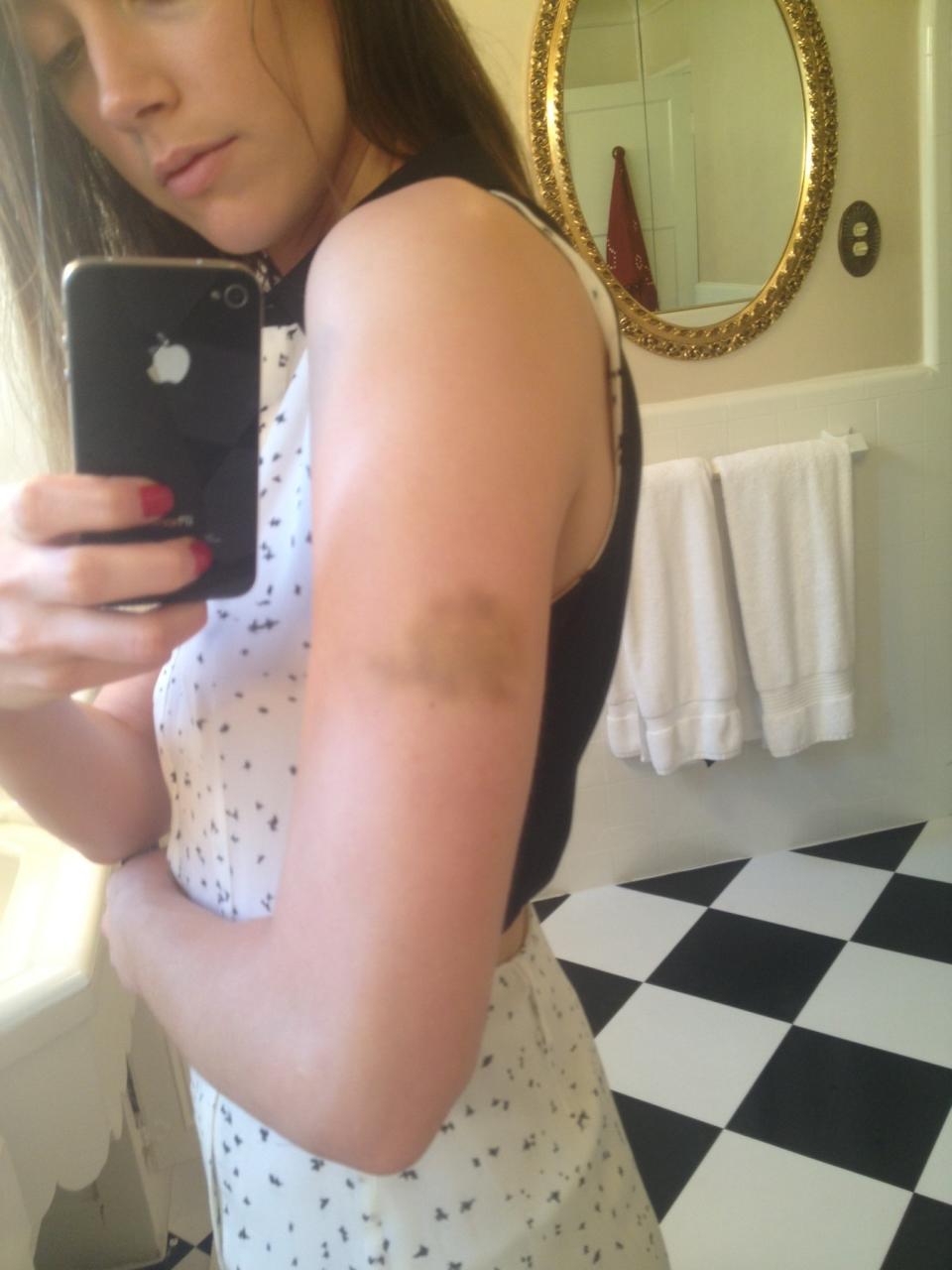A photo shown in court of a bruise on Amber Heard's arm.
