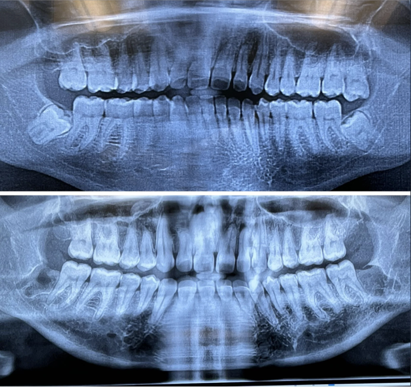 Two dental X-rays showing upper and lower teeth, used in discussing children's dental health