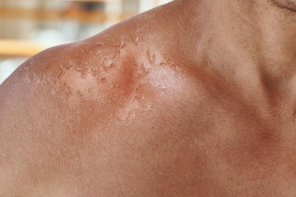 Try One of These Lotions to Soothe That Brutal Sunburn