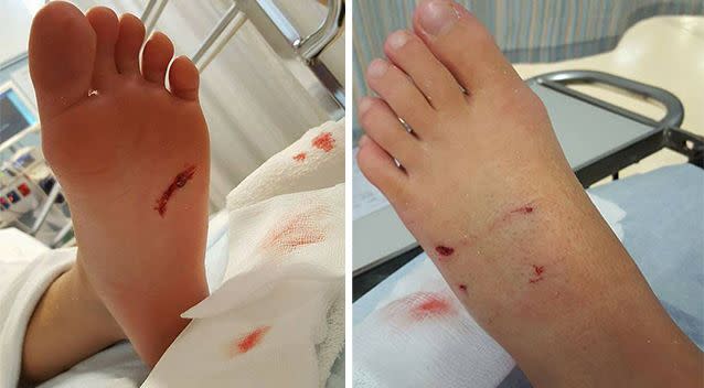 Jessica, 11, required surgery to treat the wounds to her foot. Photo: Facebook/Leanne Holland