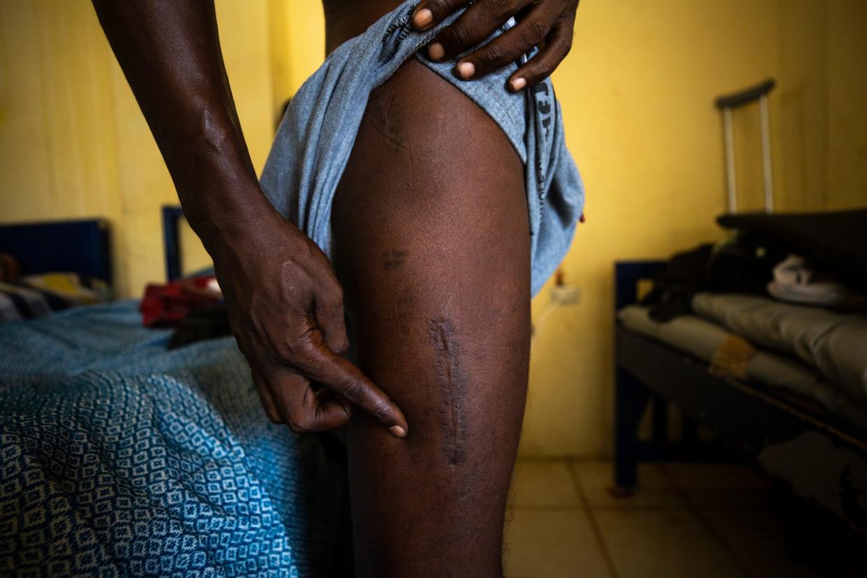 Souare Tidiane, 40, of Guinea, shows his operation scar. Tidiane was recovering at the Jesus The Good Shepherd Shelter from a femur fracture he sustained soon after he entered Mexico from Guatemala.