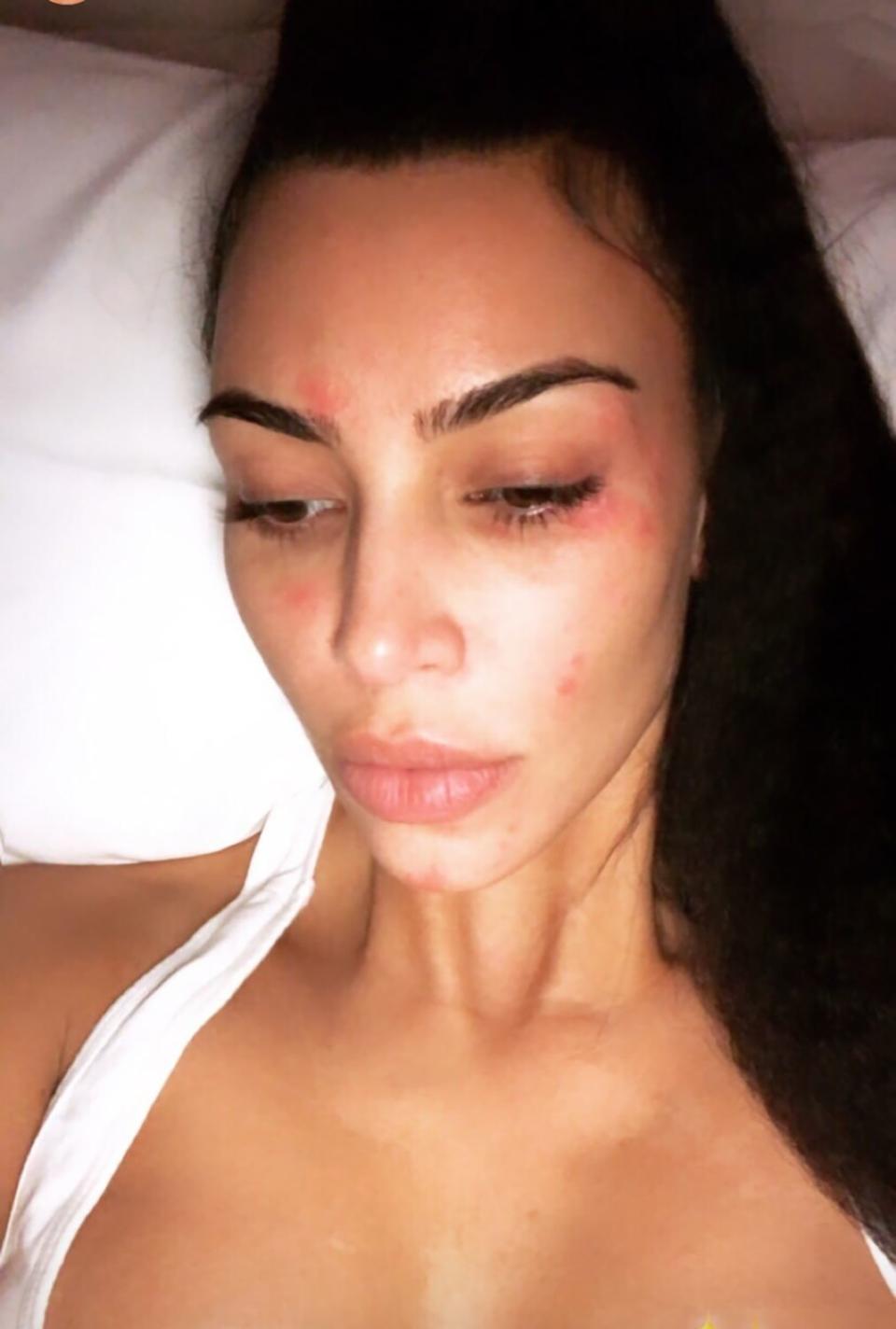 Kim's been candid with her fans about <a rel="nofollow noopener" href="https://people.com/style/everything-kim-kardashian-said-about-her-psoriasis/" target="_blank" data-ylk="slk:struggling with psoriasis;elm:context_link;itc:0;sec:content-canvas" class="link ">struggling with psoriasis</a> and revealed what the <a rel="nofollow noopener" href="https://people.com/health/kim-kardashian-shares-video-showing-psoriasis-face/" target="_blank" data-ylk="slk:flare ups look like on her face;elm:context_link;itc:0;sec:content-canvas" class="link ">flare ups look like on her face</a> before she gets glammed. 