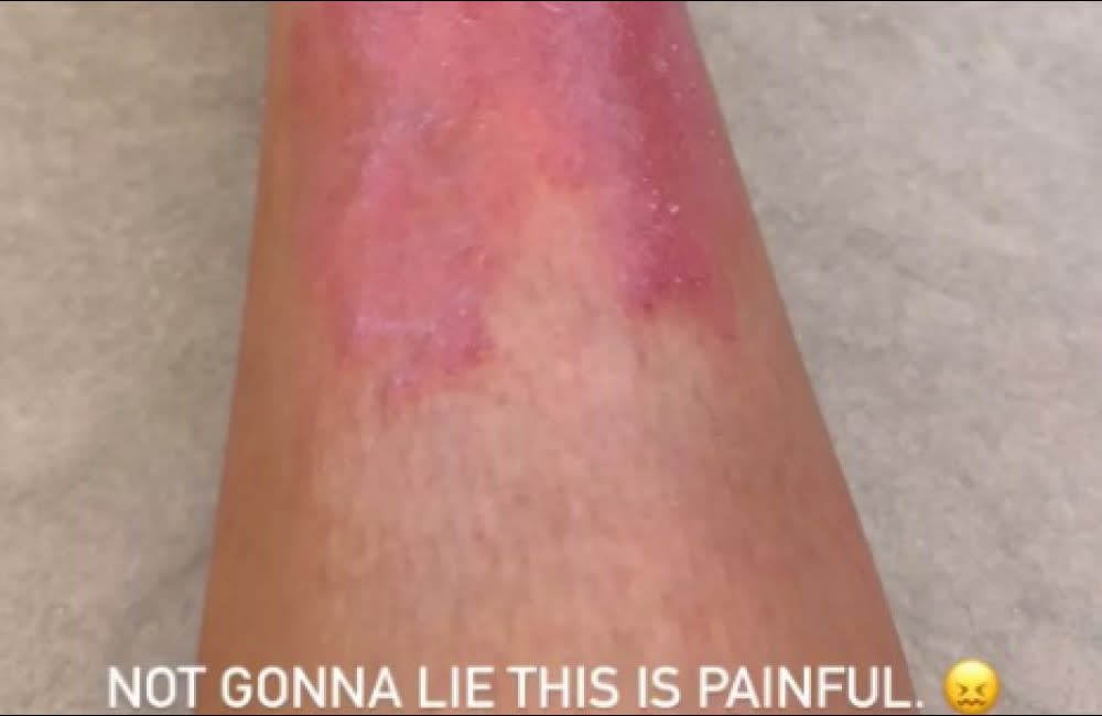 Kim Kardashian has had a painful flare-up of psoriasis credit:Bang Showbiz