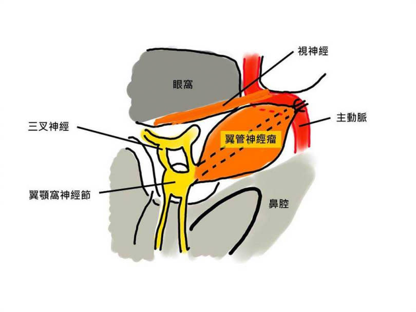 張先生翼管神經瘤翼管神經瘤位於翼顎窩，靠近眼窩、顱底與頸動脈，並沾黏翼管神經，剝除不易。（圖／台中慈濟醫院提供）