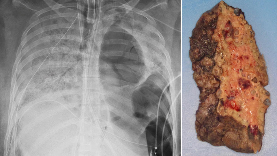 A coronavirus patient receives a lung transplant. 